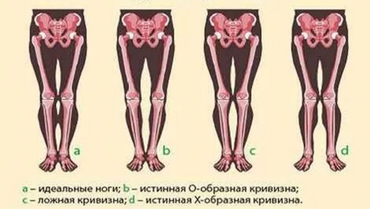 Как исправить о образную кривизну ног