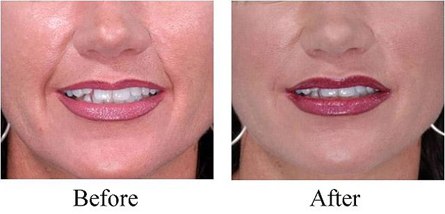 филлер Juvederm Ultra Smile