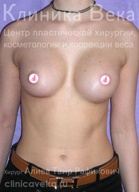 Макролайн: удаление геля, установка имплантов — Через 3 недели после операции «увеличение груди»