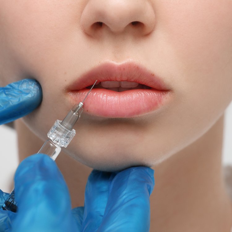 Кому показан ботокс губ – особенности процедуры и противопоказания
