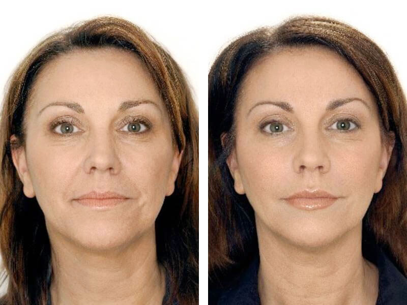 Ботокс бровей – фото до и после процедуры