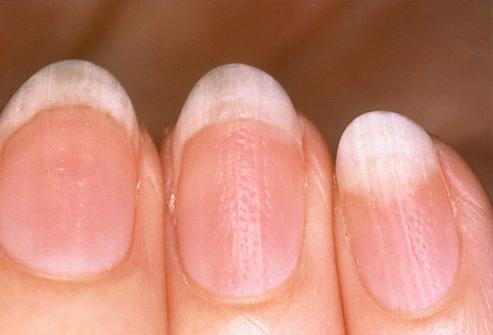 ребристые волнистые и неровные ногти на руках причины и лечение