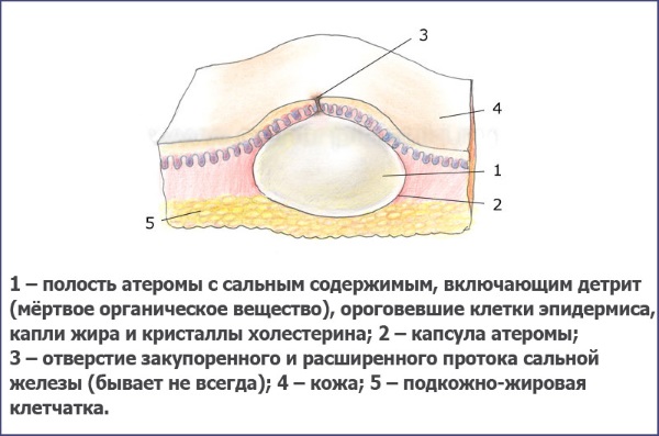 Шишка под кожей на руке, шее, лице, спине. Фото высыпания в виде бугорков. Причины и лечение