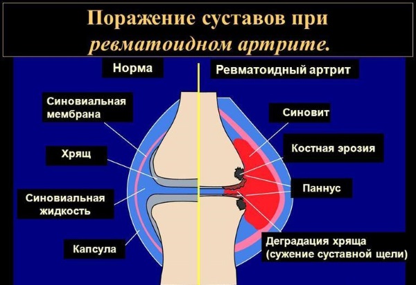 Шишка под кожей на руке, шее, лице, спине. Фото высыпания в виде бугорков. Причины и лечение