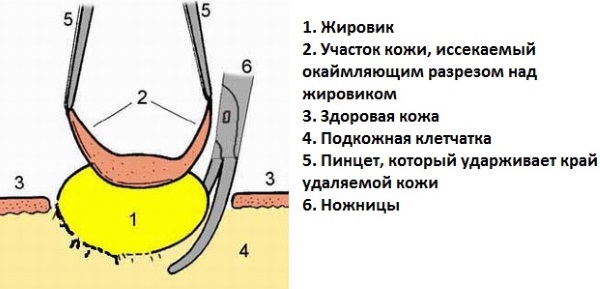 Шишка под кожей на руке, шее, лице, спине. Фото высыпания в виде бугорков. Причины и лечение