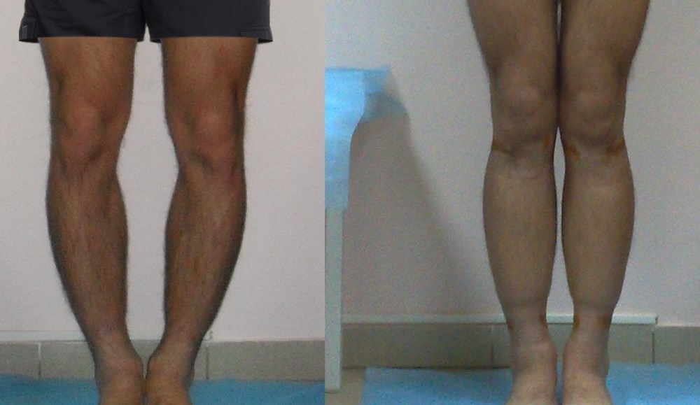 Варусная деформация голени – фото до и после операции