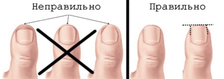 вросший ноготь: как правильно стричь ногти