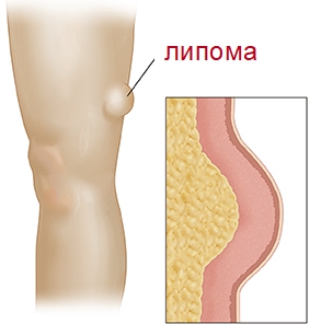 Схема образования липомы