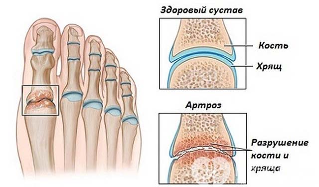 Схема развития артроза