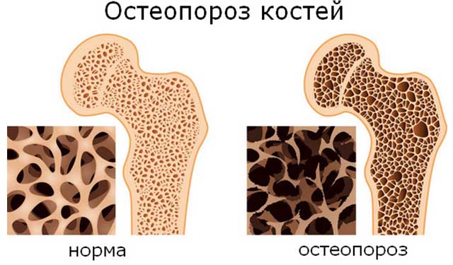 Схема костей с остеопорозом