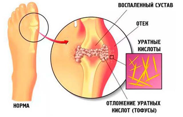 Схема развития подагры