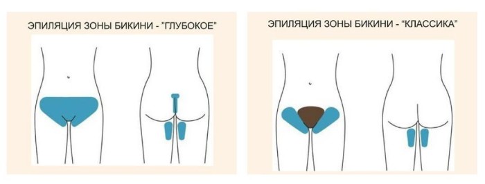 Эпиляция бикини пинцетом в домашних условиях