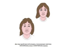лица женщин с заболеванием щитовидной железы